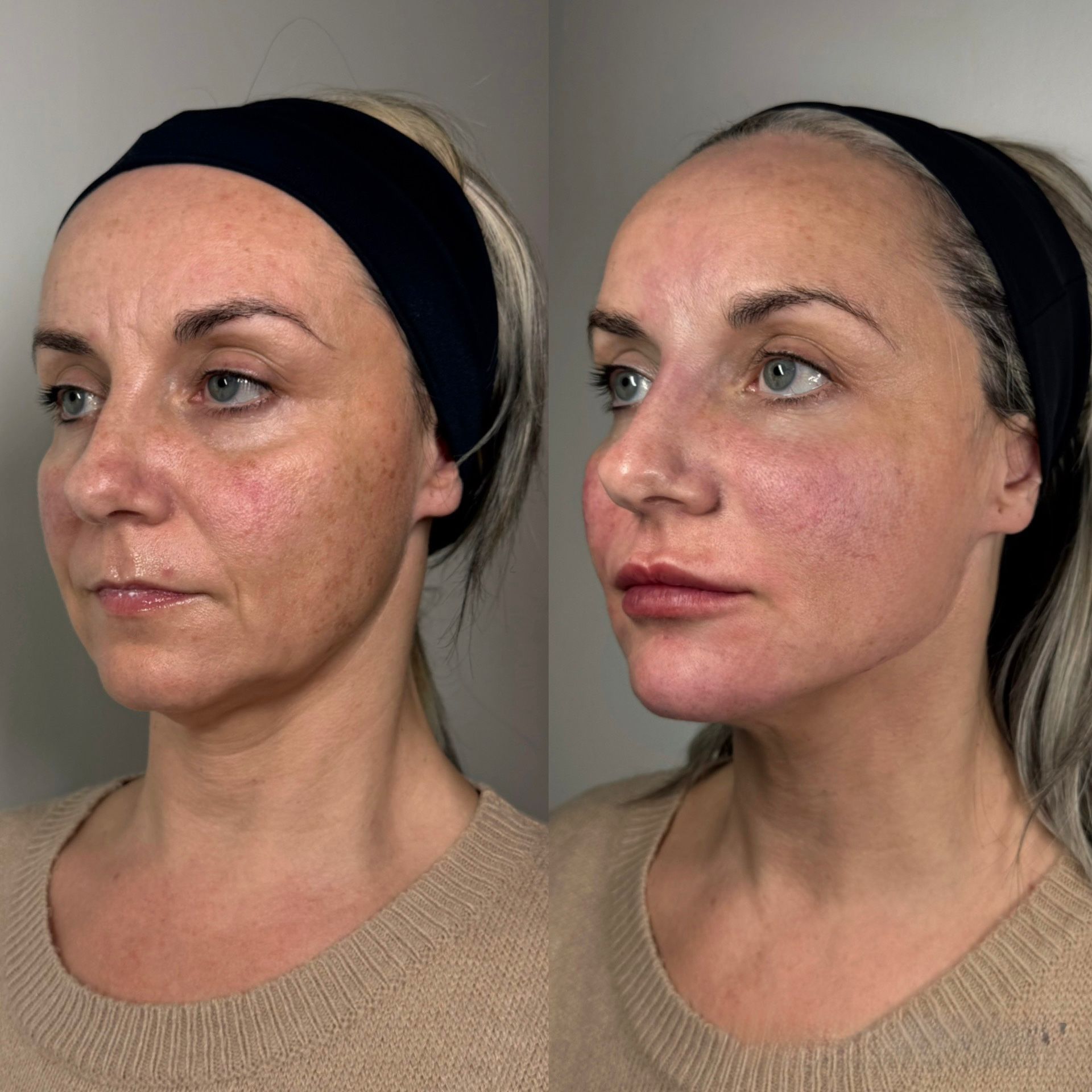 Armoniz Facial 1 (1)