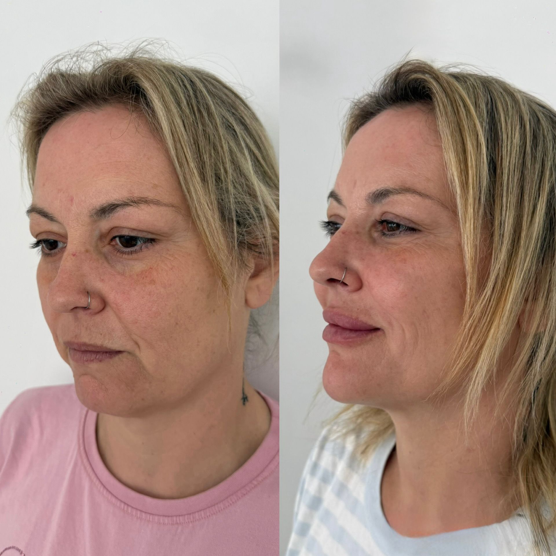 Armoniz Facial 2