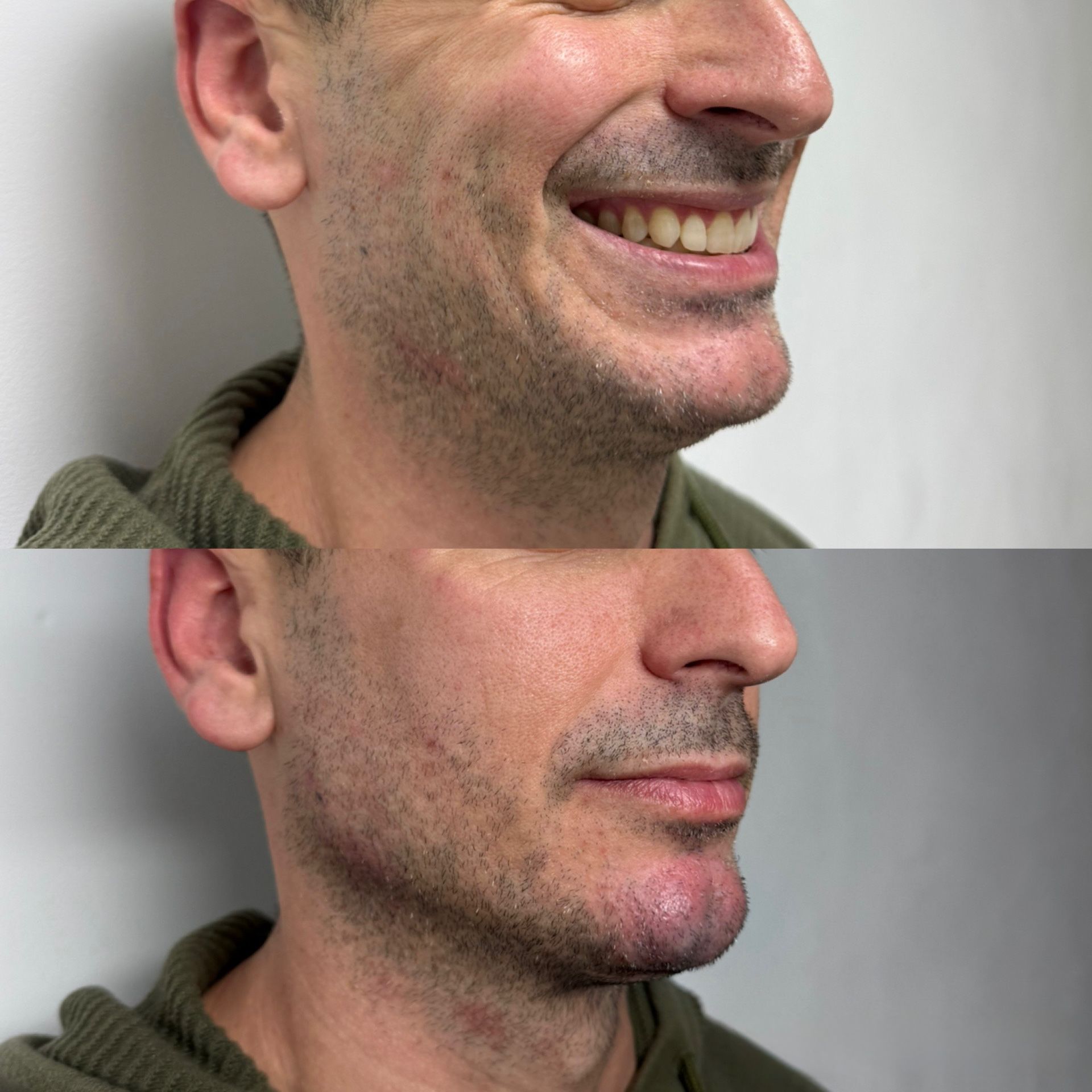 Armoniz Facial 3