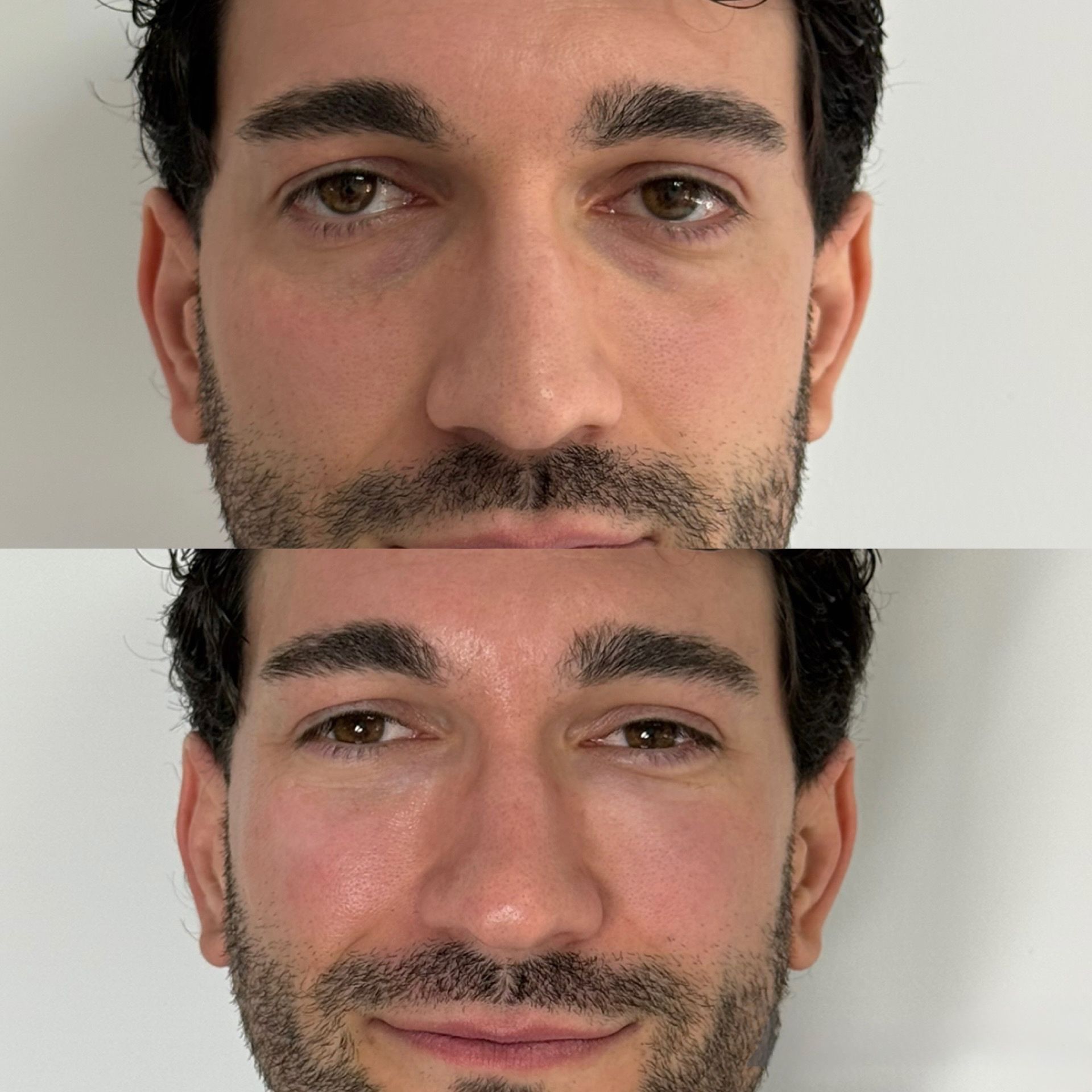 Ojeras 1
